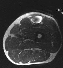 膝蓋大腿部痛症候群におけるmfMRIの筋活性化パターンについて【論文から学ぶエビデンス】