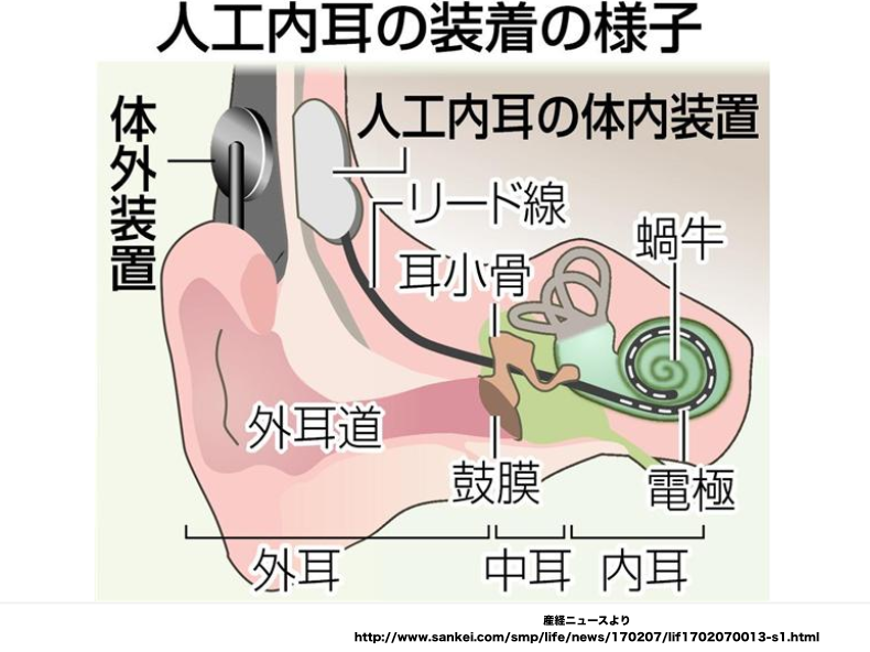 認知症対策に「人工内耳」