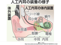 認知症対策に「人工内耳」