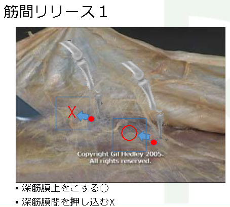 組織間リリースで何を変えられるのか？-慢性的なアキレス腱炎に対して-