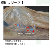 組織間リリースで何を変えられるのか？-慢性的なアキレス腱炎に対して-
