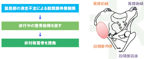 鼠径部痛症候群はリアラインで治す