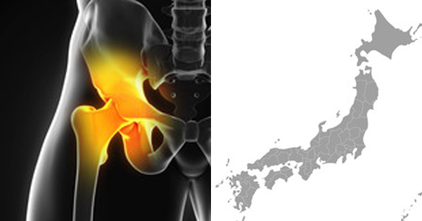 大腿骨骨折発生頻度の地域差、最大で2倍程度