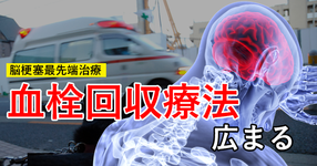 脳梗塞最先端治療 「血栓回収療法」広まる