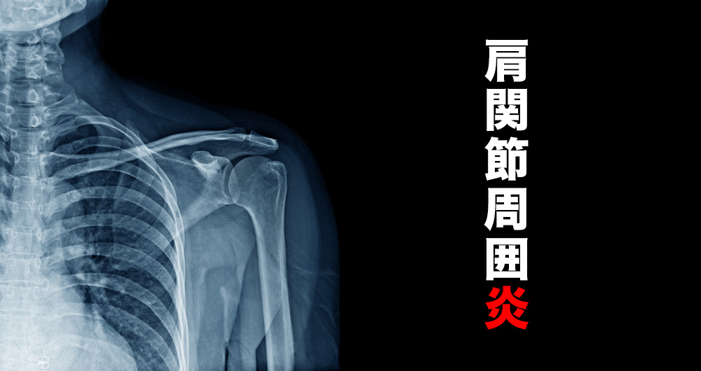 肩関節周囲炎とは