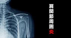 肩関節周囲炎とは