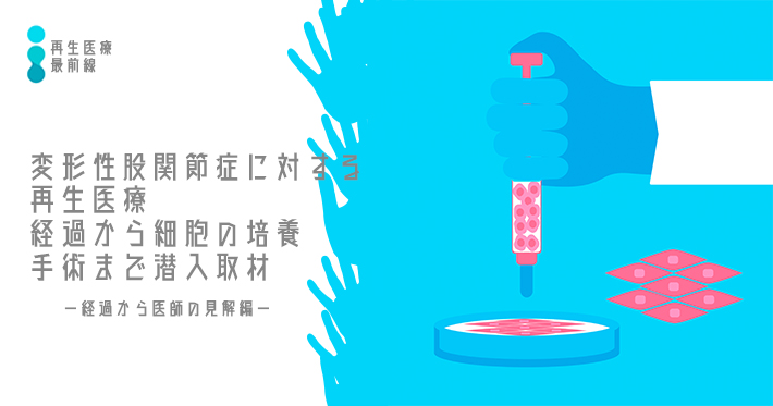 【再生医療最前線】変形性股関節症に対する間葉系幹細胞 (mesenchymal stem cell : MSC)-経過から医師の見解編-