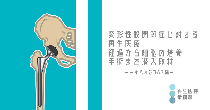 【再生医療最前線No.2】変形性股関節症に対する間葉系幹細胞 (mesenchymal stem cell : MSC)-一か八かでTHA？編