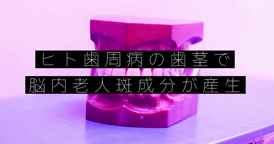 ヒト歯周病の歯茎で脳内老人斑成分が産生 九州大が発表
