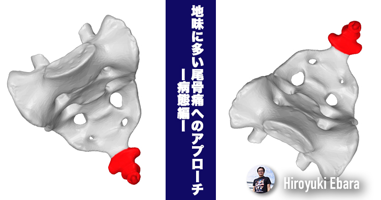 地味に多い尾骨痛へのアプローチ～病態編～