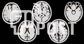 MRI脳画像｜スライス画像（中心溝、側脳室、基底核、中脳、小脳）５枚