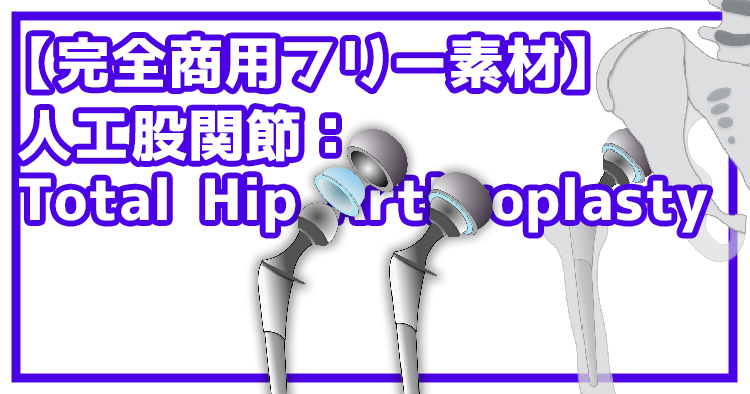 【完全商用フリー素材】自由に動かせる人工股関節（THA:Total Hip Arthroplasty）#2