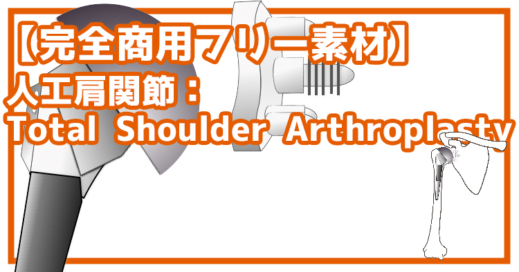 【完全商用フリー素材】自由に動かせる人工肩関節（THA:Total Shoulder Arthroplasty）#2