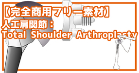 【完全商用フリー素材】自由に動かせる人工肩関節（THA:Total Shoulder Arthroplasty）#2