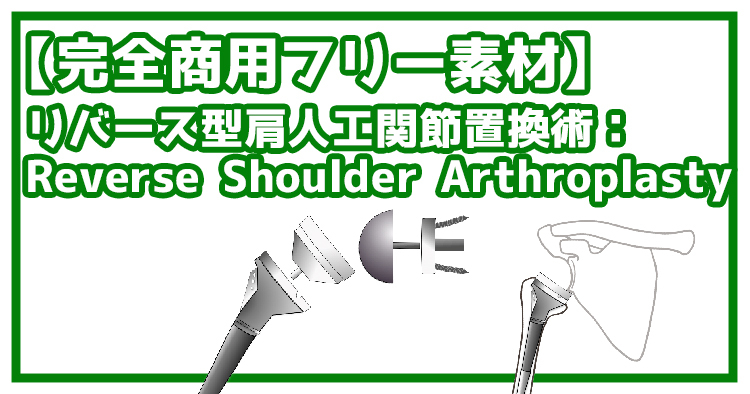 【完全商用フリー素材】リバース型肩人工関節置換術（RSA：Reverse Shoulder Arthroplasty）#2