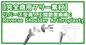 【完全商用フリー素材】リバース型肩人工関節置換術（RSA：Reverse Shoulder Arthroplasty）#2