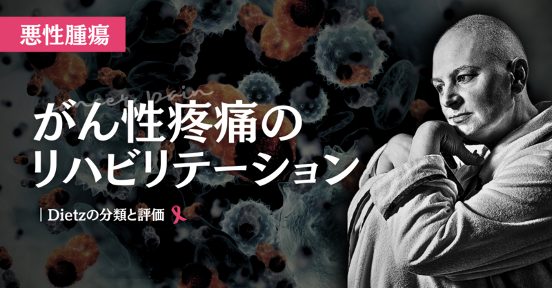 がん性疼痛のリハビリテーション | 理学療法士・作業療法士・言語聴覚