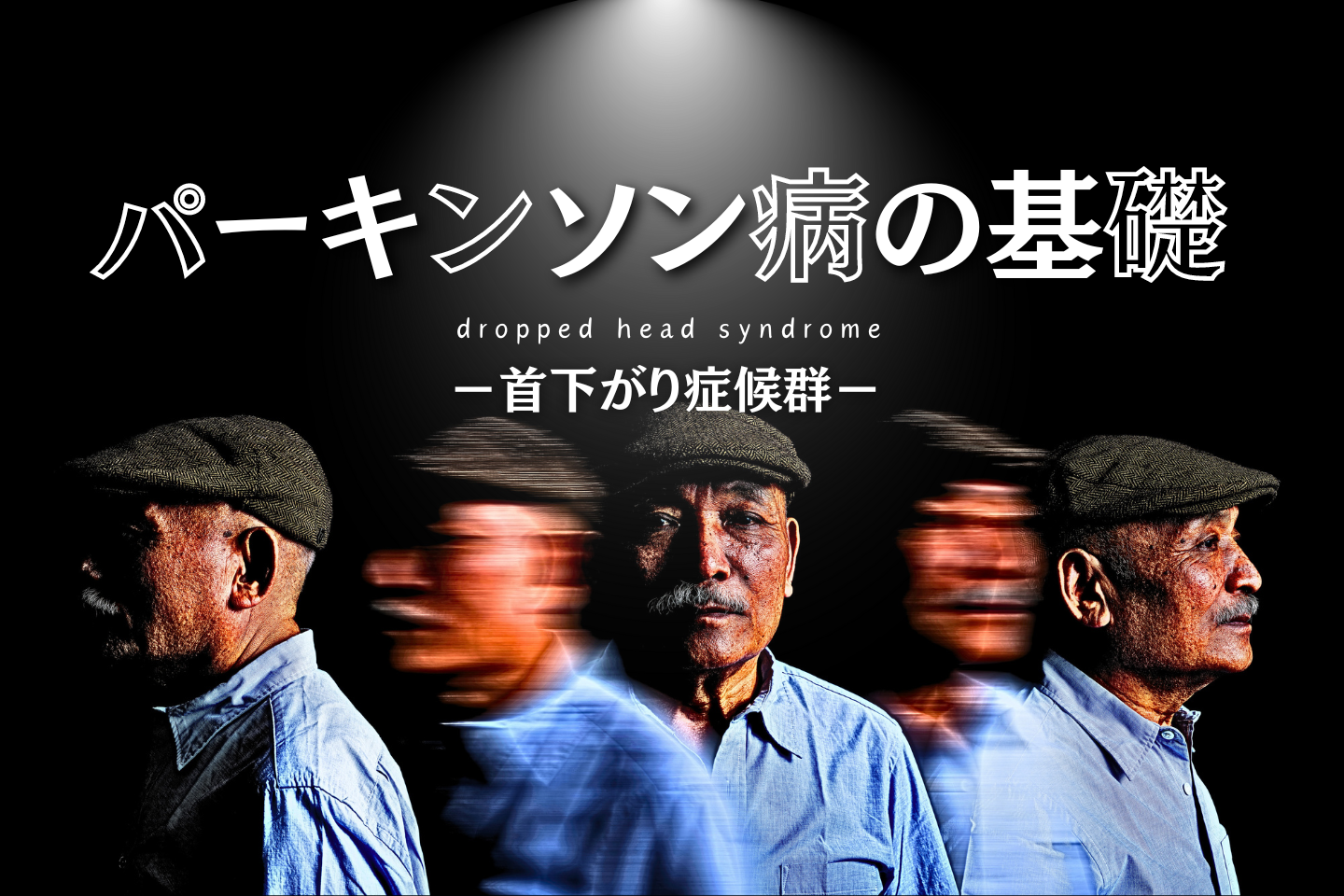 パーキンソン病-首下がり-