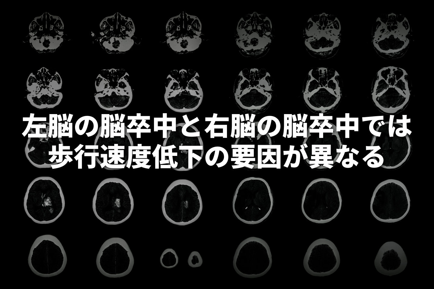 左脳の脳卒中と右脳の脳卒中では歩行速度低下の要因が異なる -個別化されたより効果的な歩行リハビリテーションの開発に期待-