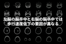 左脳の脳卒中と右脳の脳卒中では歩行速度低下の要因が異なる -個別化されたより効果的な歩行リハビリテーションの開発に期待-