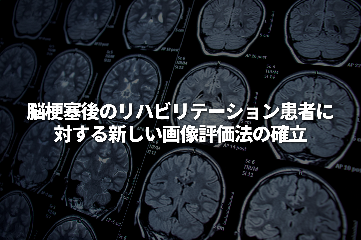脳梗塞後のリハビリテーション患者に対する新しい画像評価法の確立 （―脳梗塞後の虚血巣における鉄と髄鞘の縦断的変化と神経学的予後との関連―）