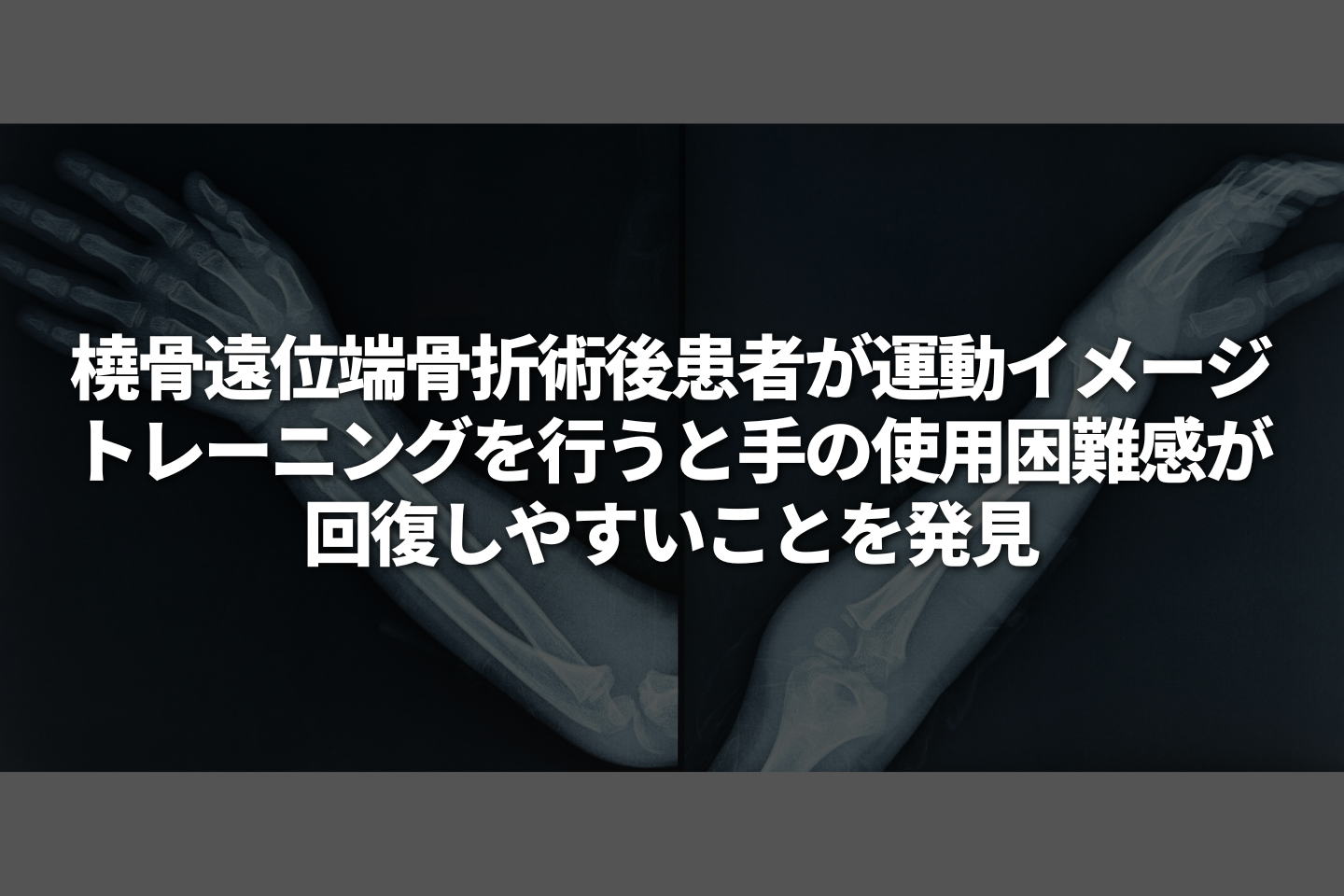 橈骨遠位端骨折術後患者が運動イメージトレーニングを行うと手の使用困難感が回復しやすいことを発見