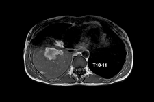 腰痛患者は胸腰筋膜が厚く硬い　14研究1001人のメタ分析