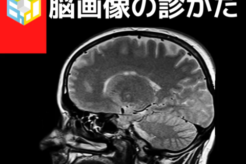 若手理学療法士・作業療法士のための脳画像の診かた｜小脳の知識と脳画像の結びつけ