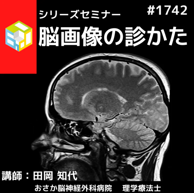 若手理学療法士・作業療法士のための脳画像の診かた|小脳の知識と脳画像の結びつけ